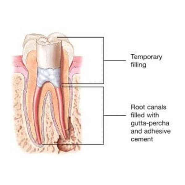Graphic of a temporary filling and root canals